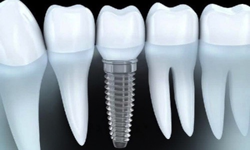 Dentistes Saint Marcellin implants dentaires